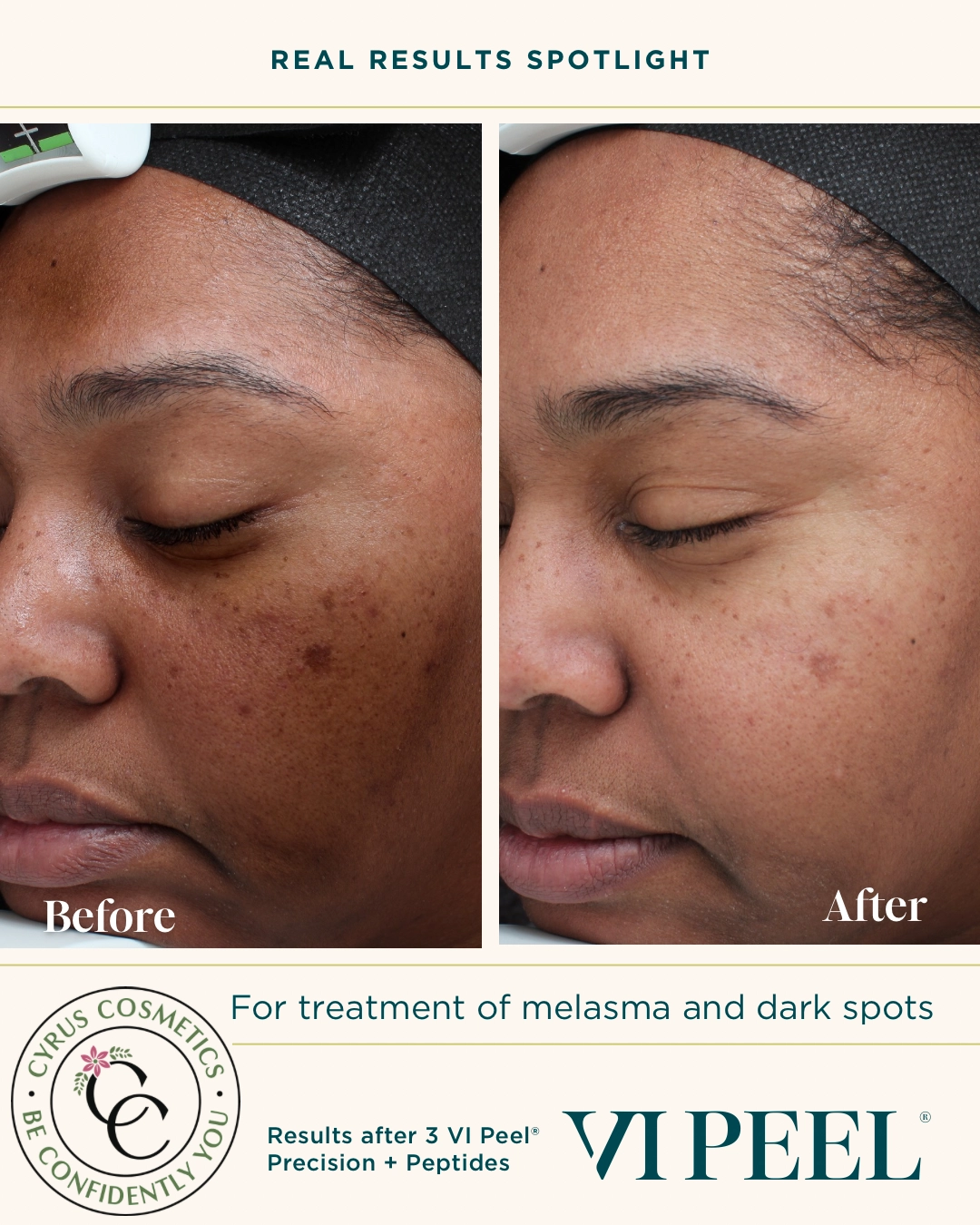 VI Peel Precision Plus and Peptides before-and-after results following three treatments.