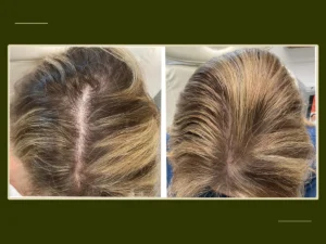 PP405 Hair Growth Treatment
