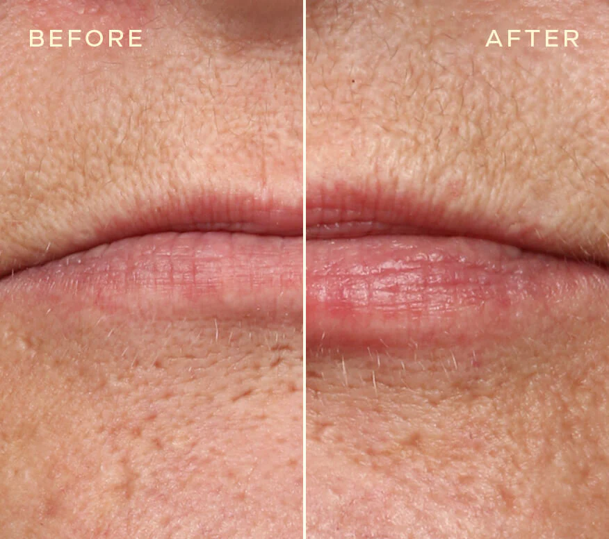 Achieve Natural-Looking Lips with Our Innovative Lip Filler Refill - Image 3