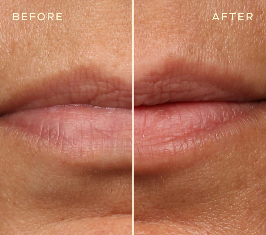Achieve Natural-Looking Lips with Our Innovative Lip Filler Refill - Image 2