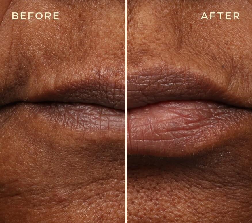 Achieve Natural-Looking Lips with Our Innovative Lip Filler Refill - Image 4