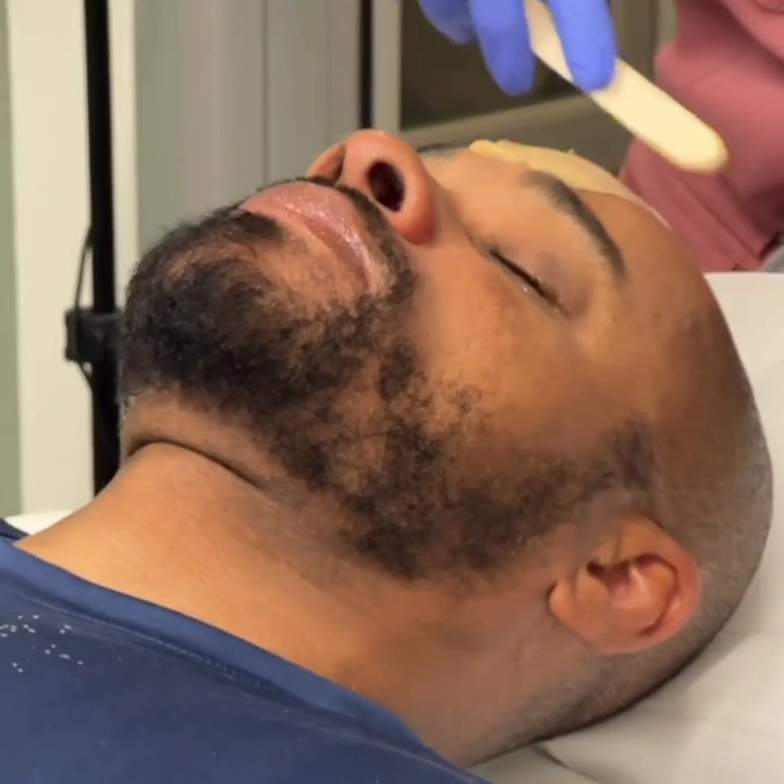 Medical-Grade Chemical Peels in Fresno